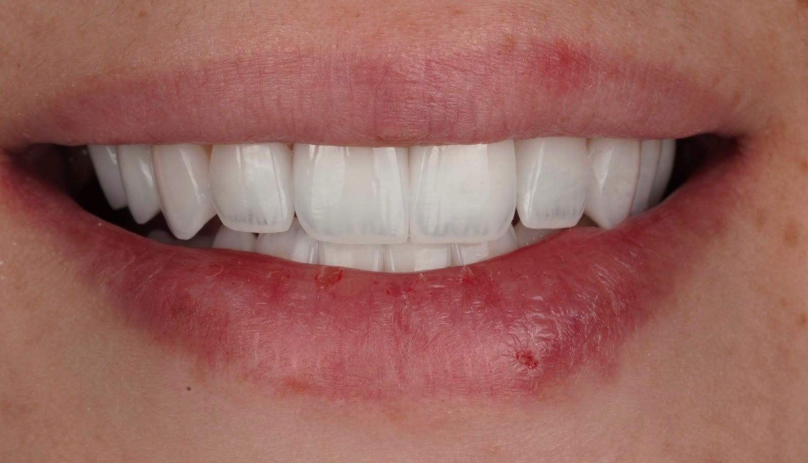 Result after dental veneers in Tabarbour on the upper front teeth