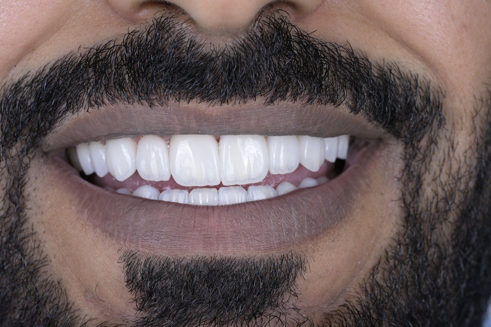 Smile after porcelain veneers in Tabarbour Amman
