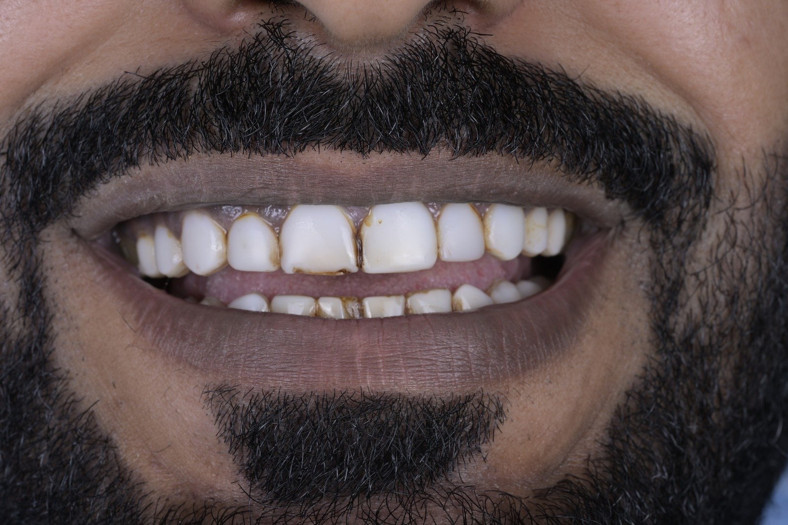 Front teeth before veneer placement at Zoom Dental Clinic