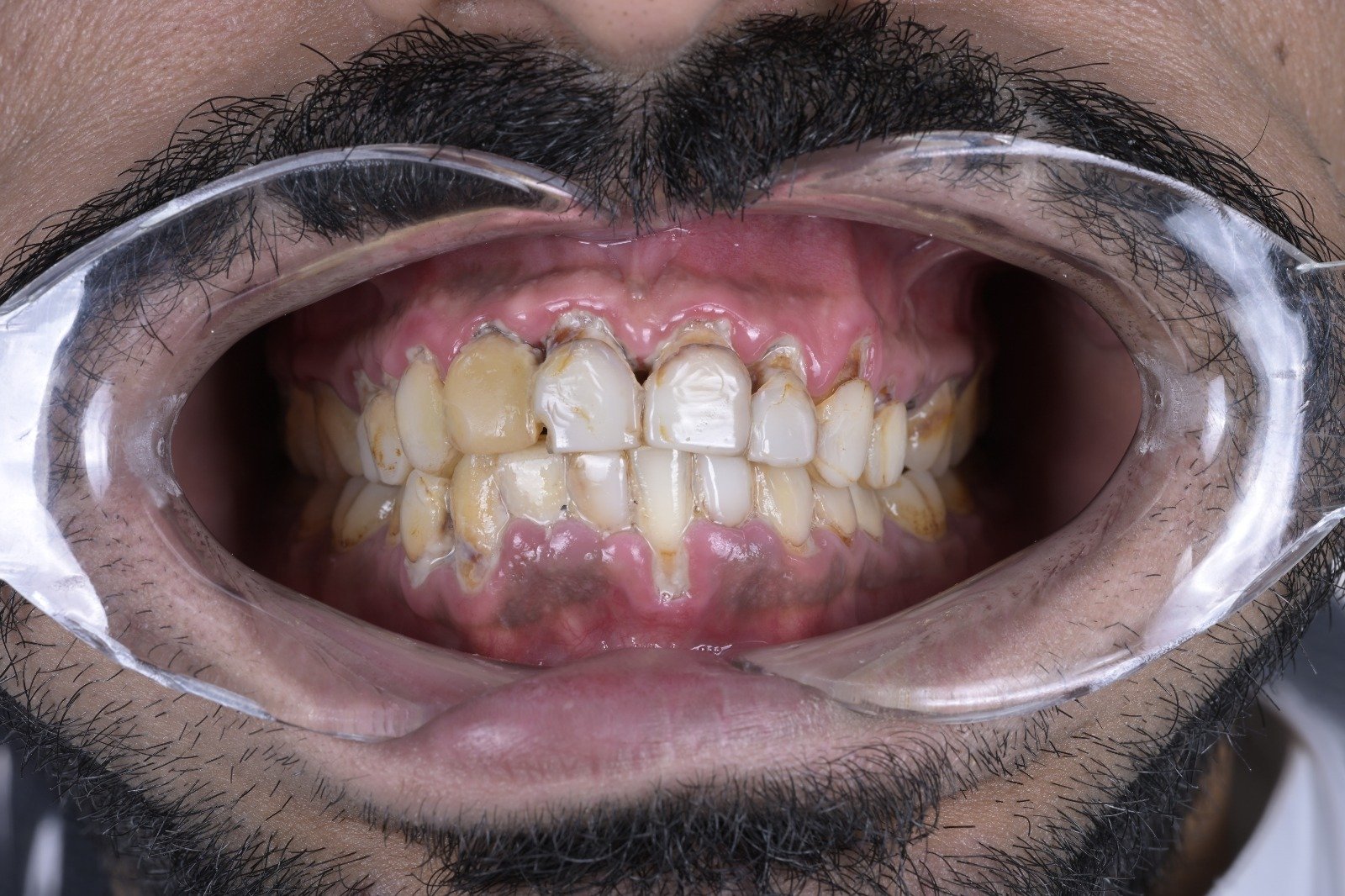 Case before zirconia restorations at a dental clinic in Tabarbour