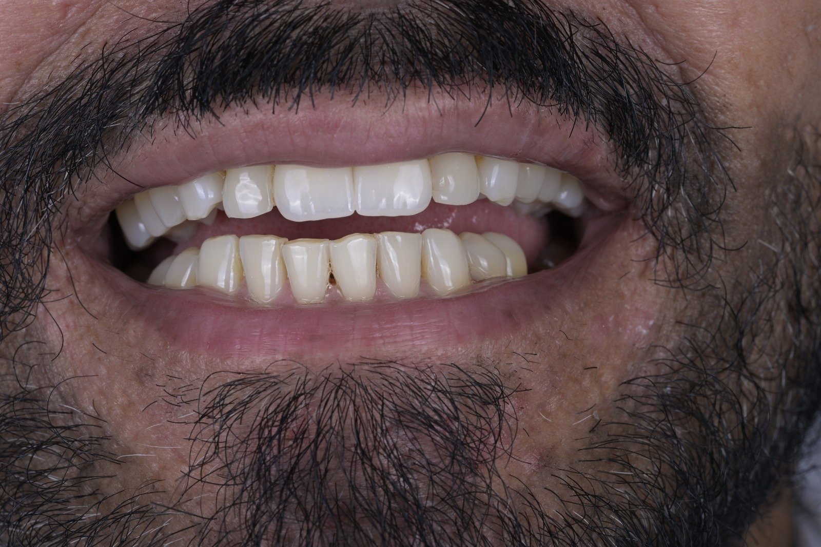 Natural-looking result of E.max restorations at Zoom Dental Clinic