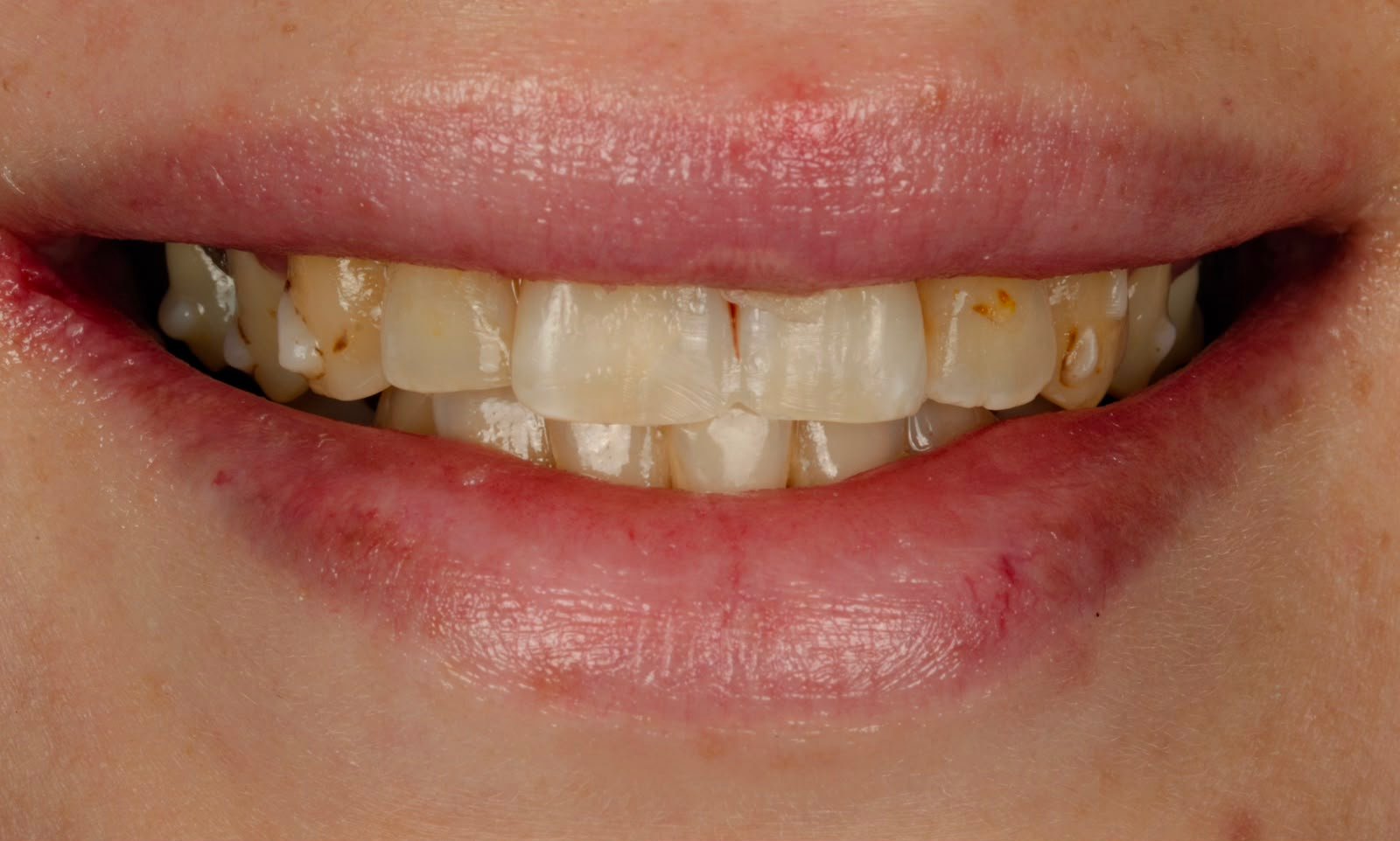 Veneer case before treatment at a dental clinic in Tabarbour