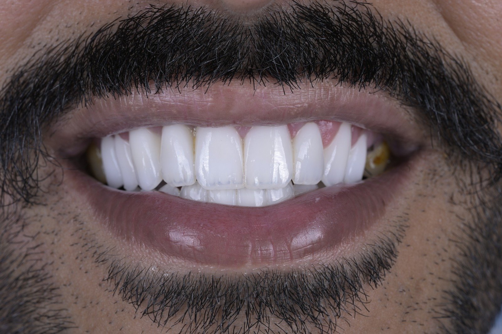 Result of zirconia dental restorations at Zoom Dental Clinic Tabarbour
