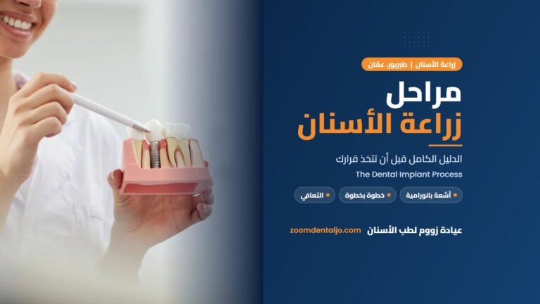 مراحل زراعة الأسنان | دليل عيادة زووم لطب الأسنان في طبربور