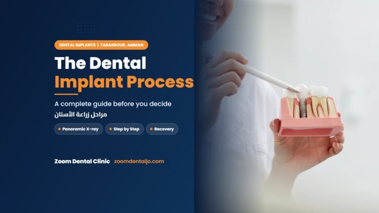 The dental implant process | guide by Zoom Dental Clinic in Tabarbour