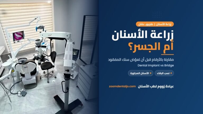 زراعة الأسنان أم الجسر: مقارنة من عيادة زووم لطب الأسنان